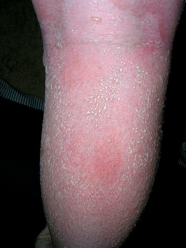 Close up of a badly sunburned leg.