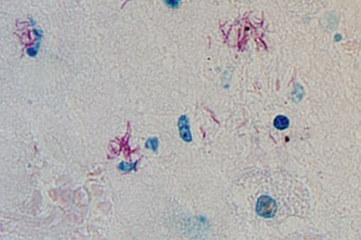 TB bacteria in the lung - the bacteria are stained red