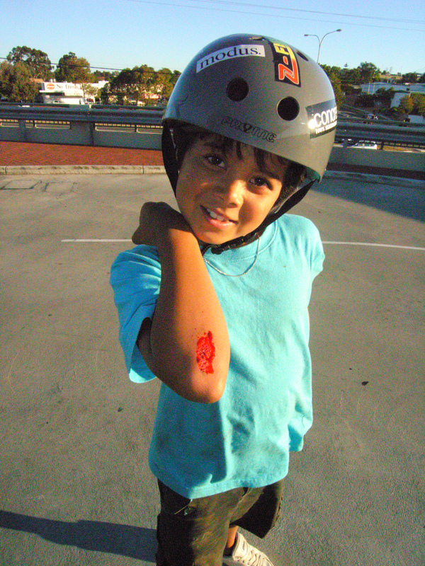 Boy wearing a cycle helmet showing his bleeding grazed elbow.