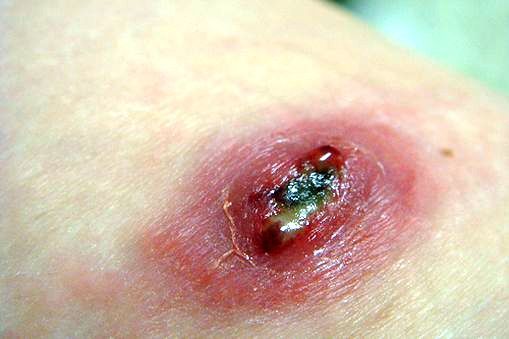 Close up of a skin infection from a cut. 