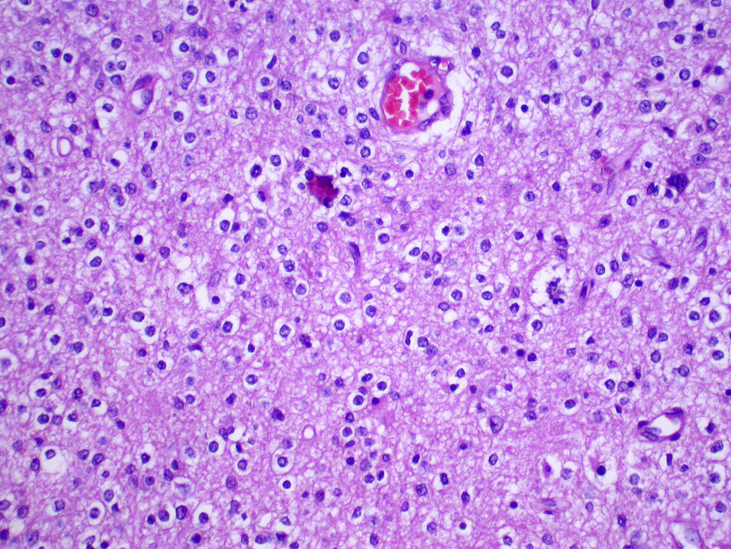 Human brain tissue sample with H&E stain of nuclei of the cells.