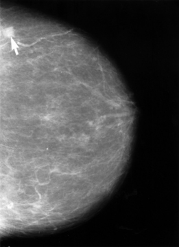 A mammogram with arrow pointing to location of breast cancer. 
