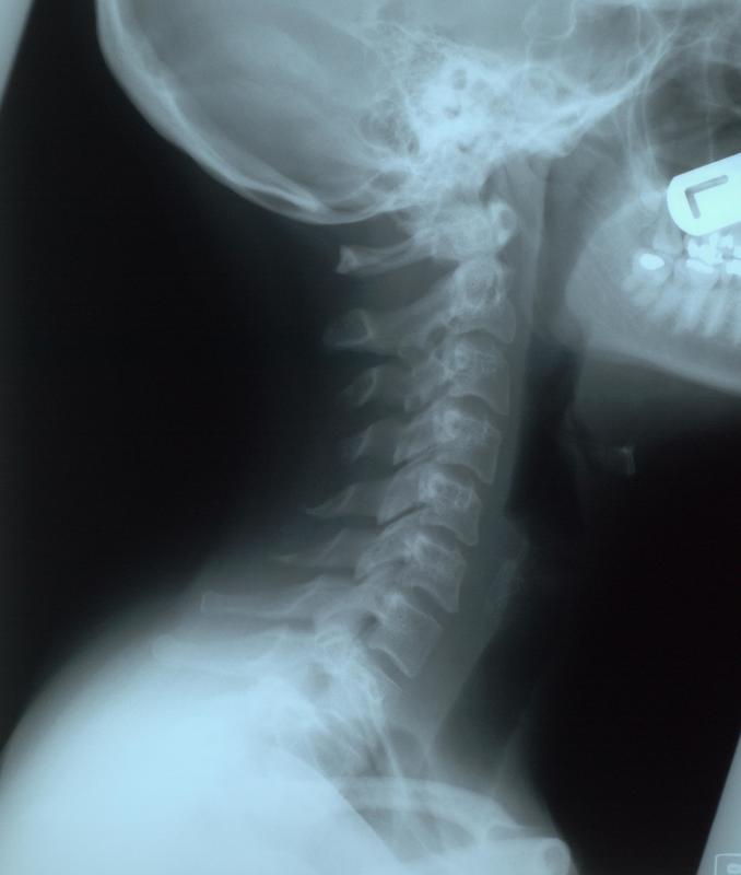 X-ray of vertebral column, base of skull, mandible and shoulder.