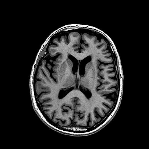 Transverse view of a 75 year old male's brain taken with a MRI.