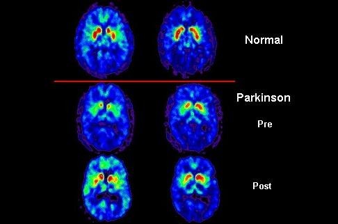PET scans showing changes caused by Parkinson's Disease.