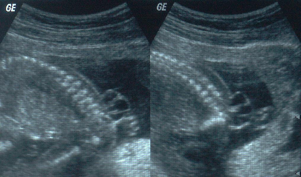 Ultrasound scan showing a neural tube defect on an unborn baby.