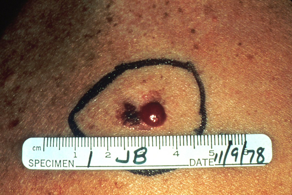 An advanced melanoma circled with pen and rule measurement.