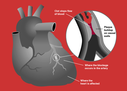 Heart attack diagram, insert of an artery blockage.