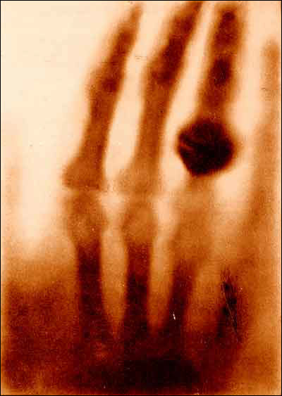1895 first X-ray image - a hand with a wedding ring.