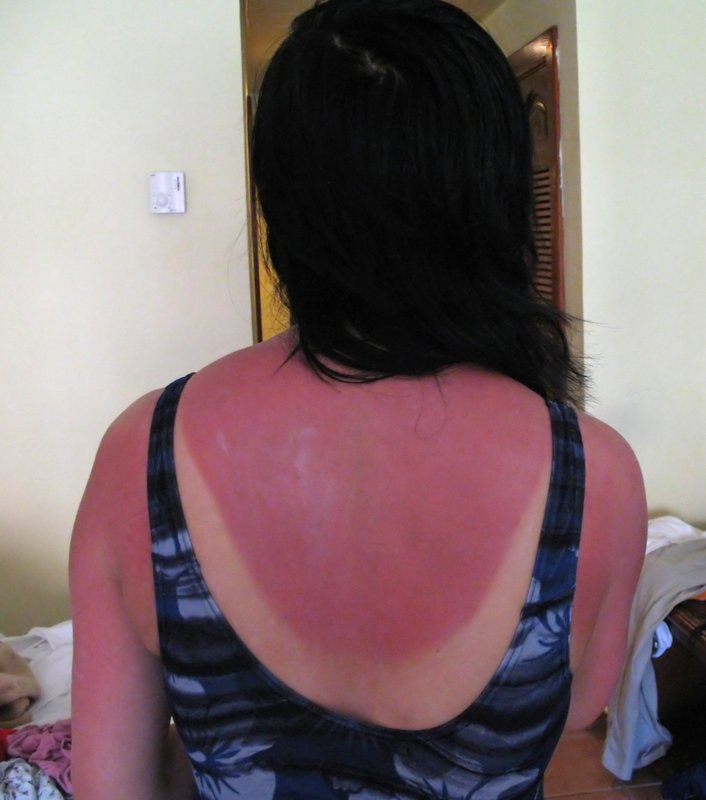 Woman's 2-day old badly sunburnt back. 