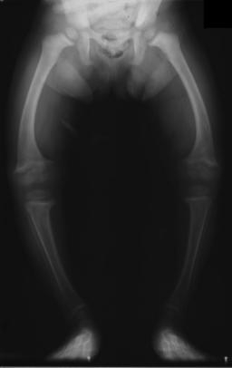 X-ray of child with rickets, showing the typical bowing of legs.