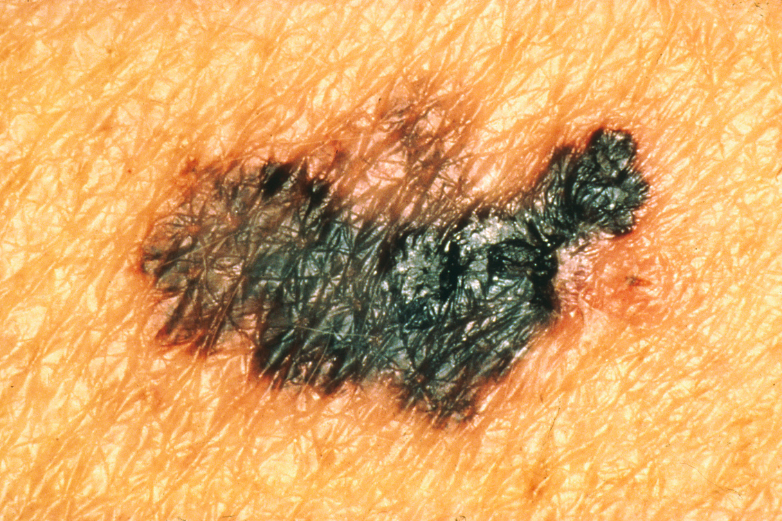 Image of a typical melanoma showing colour differences.