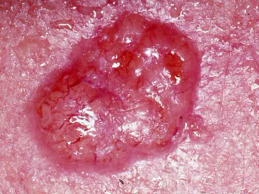 Close up of a red sore form of basal cell carcinoma.