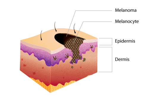 A cross section diagram of the skin, including melanocytes