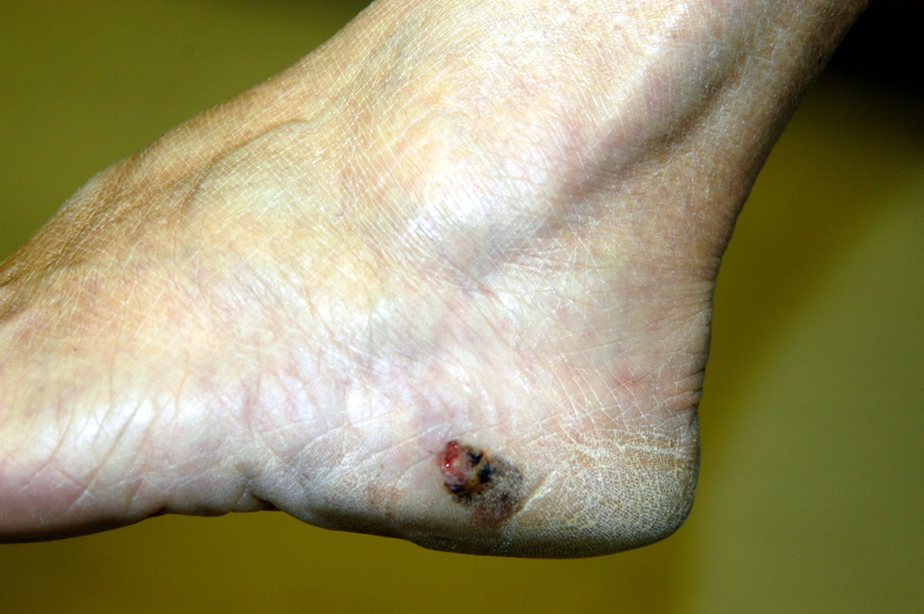 A small melanoma on a foot.