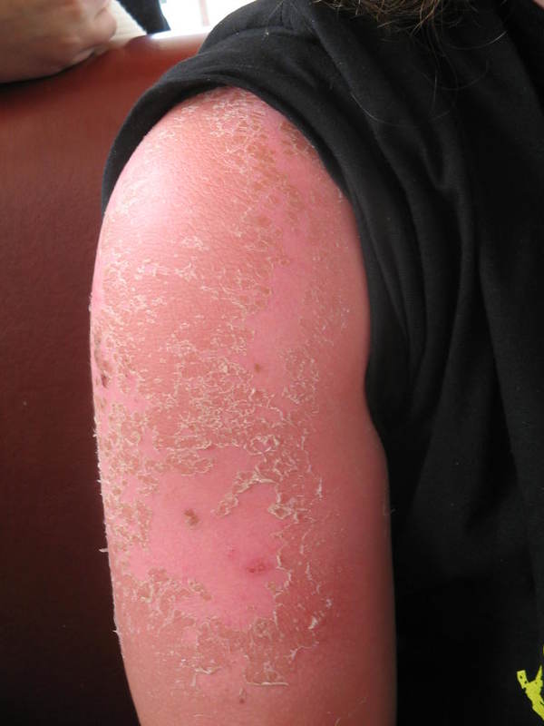 Sunburned and peeling upper arm.