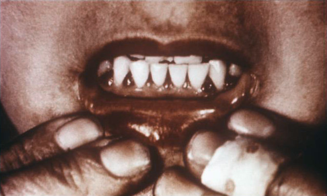 A 1970 image of scorbutic gums, a symptom of scurvy.