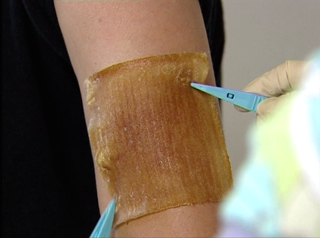 Comvita ApiNate® wound dressing being applied to an arm.