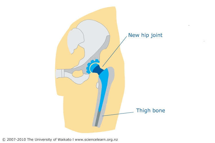 Diagram of a hip replacement.