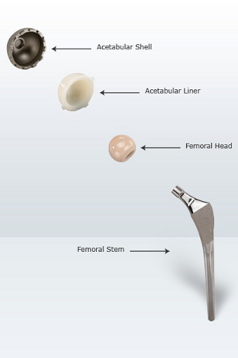 diagram showing various Hip replacement components.