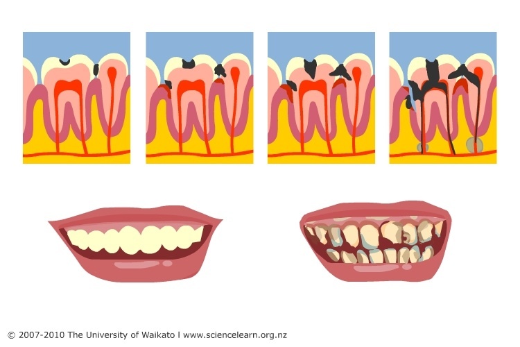 Tooth decay diagram.
