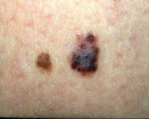 Melanoma is a cancer in the pigment-producing cells of the skin.