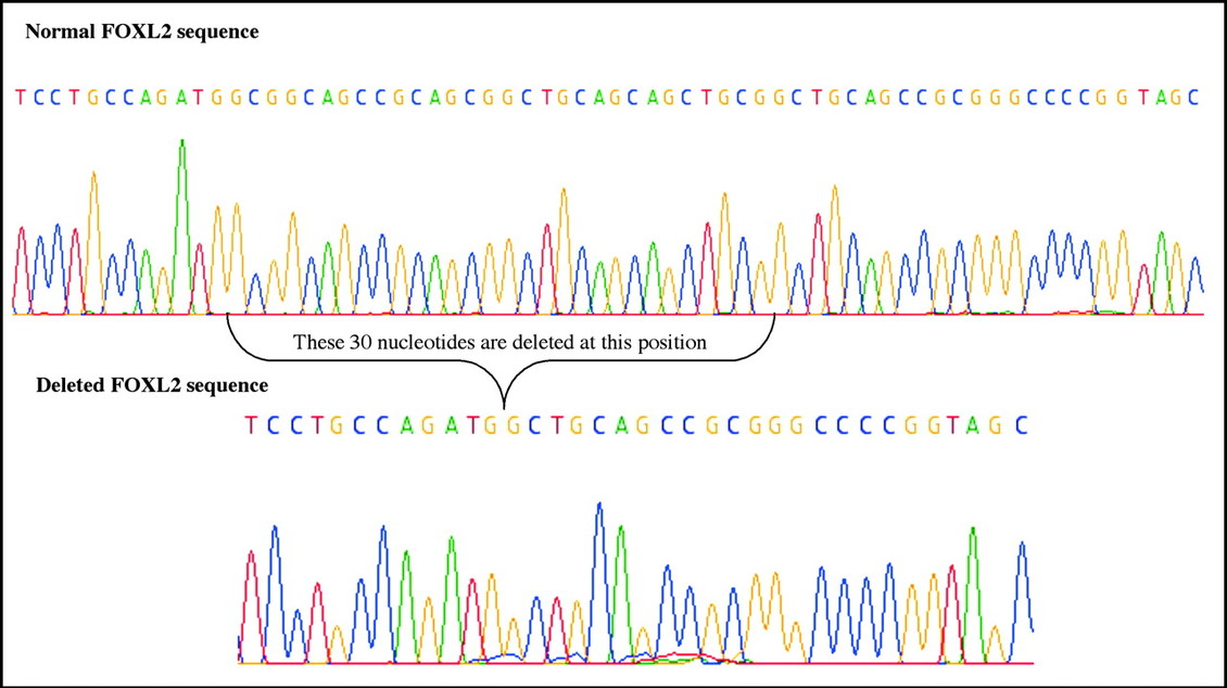 DNA sequencing results to find gene variations.