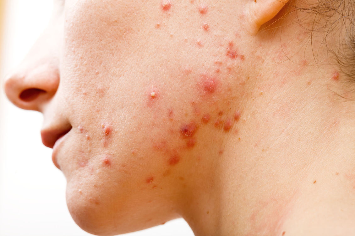 Close up of a teenagers face showing acne.