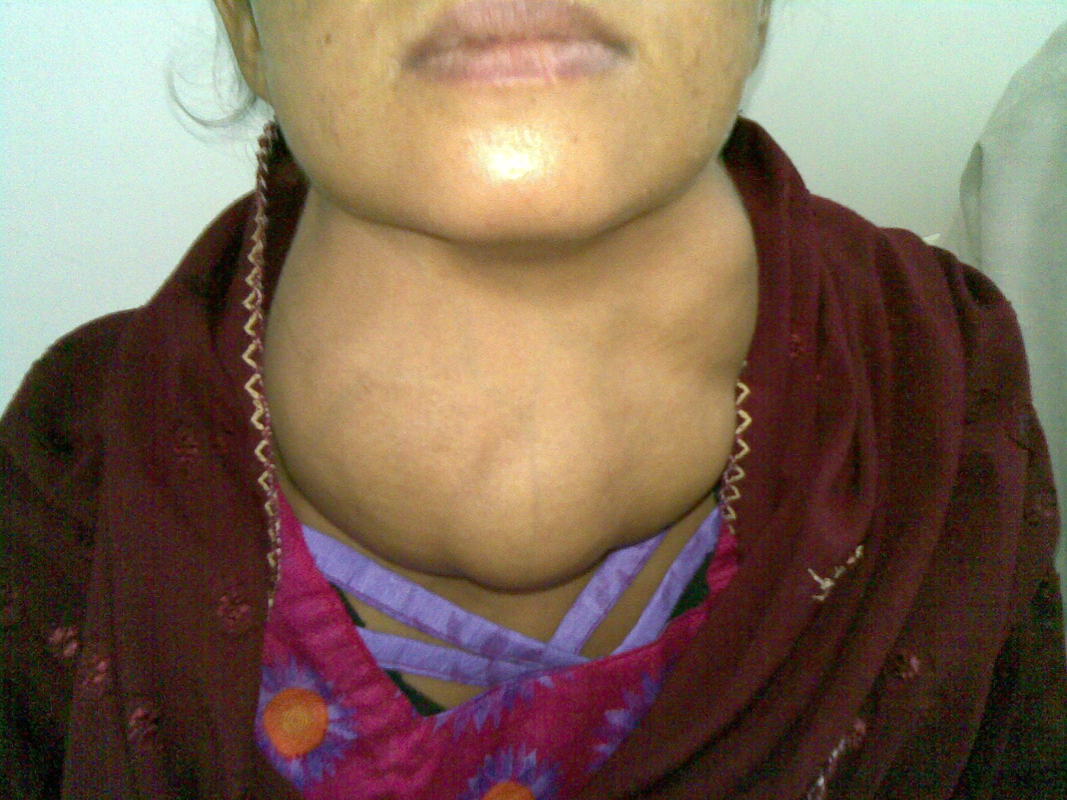 Womans' neck with goitre an enlargement of the thyroid gland