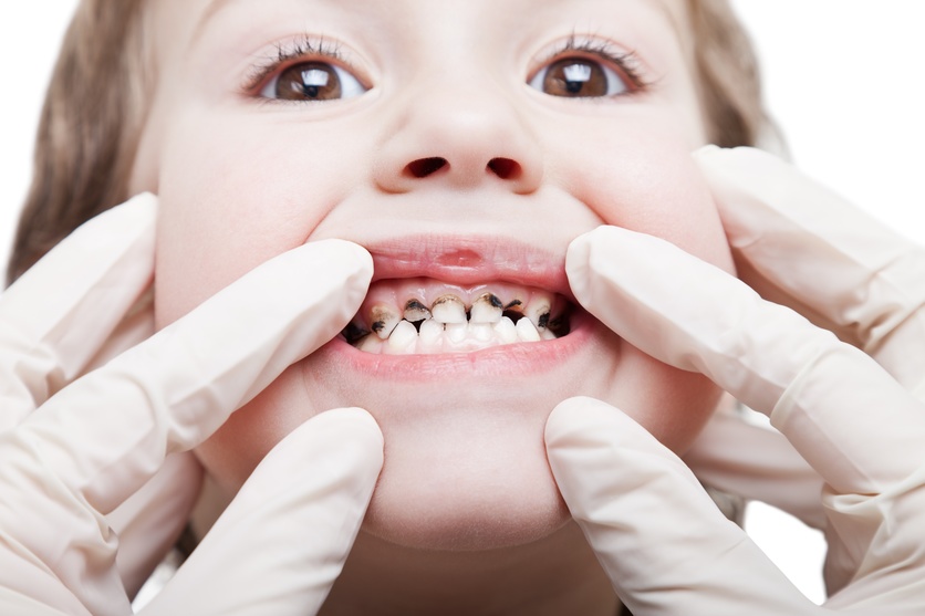Child with mouth held open showing cavities and teeth decay