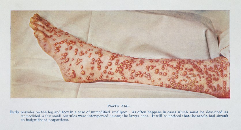 1908 image of early smallpox pustules on patient's leg and foot