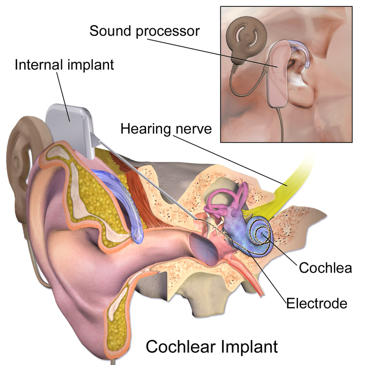 Diagram of cochlear implant.